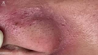 Big Cystic Acne Blackheads Extraction Blackheads & Milia, Whiteheads Removal Pimple Popping