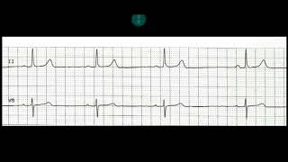 sinus Brady cardia