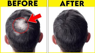 Take These 7 Vitamins To Stop Losing Hair NOW!