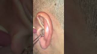 Ear pimple