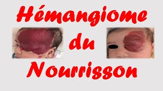 hémangiome du nourisson