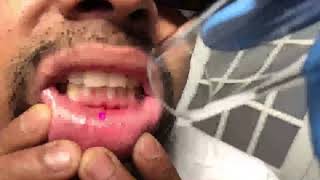 Inside the lip ( inside the mouth) tattoo laser tattoo removal