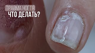 ШИШКА НА КУТИКУЛЕ 🤕 ТРАВМА НОГТЯ: ЧТО ДЕЛАТЬ? ⛔️ ДВОЙНАЯ КУТИКУЛА ✨ СВЕТООТРАЩАЮЩИЙ АКРИГЕЛЬ