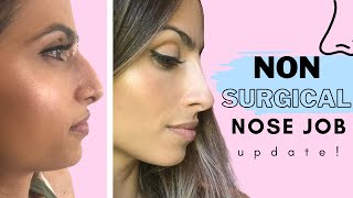 I Got A Non Surgical Nose Job in Beverly Hills, After 1+ Years | How Much Did it Cost? Did it Last?