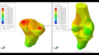 Analyzing knee compartment load for arthritic patient under variable midsole wedge angle