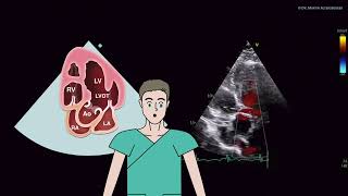 〖Echocardiography〗 Apical views - the 5-ChV, AR, use of CW❣️