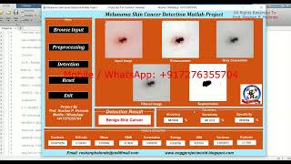 Melanoma Skin Cancer Detection Image Processing Using Matlab | Final Year Project Code IEEE Project