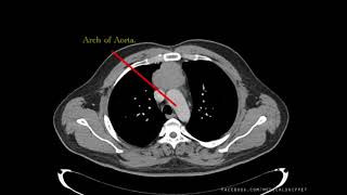 CT Thorax - How to Read