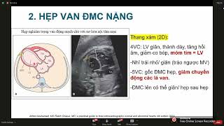 BỆNH TIM BẨM SINH CÓ TUẦN HOÀN HỆ THỐNG PHỤ THUỘC ỐNG ĐỘNG MẠCH | TS. BS. LÊ KIM TUYẾN