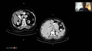 Radiology by Dr. Avik Bhattacharya - Triphasic CECT (23.09.23)