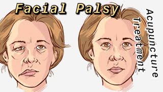 Facial Palsy & Acupuncture Treatment