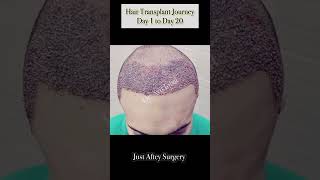 Hair Transplant Journey #hairfall #hairproblems #shorts #dermatologist