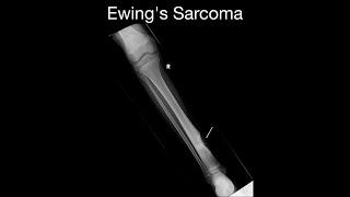 Ewing's Sarcoma