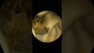 Asteroid Sized Earwax Destroyed😳