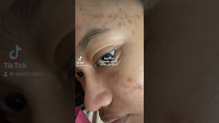 Yakin mau BODO AMAT dgn #jerawat mu? #acnescars  #acneproneskin #acne #acnetreatment #acneremoval