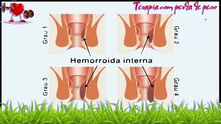 Saúde -   7 opções de tratamento para hemorroida interna