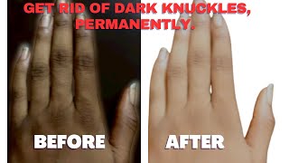 LIGHTEN DARK KNUCKLES, ELBOWS AND FEET IN A WEEK | VERY EFFECTIVE. #juditheffect