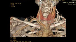 Torasik outlet sendromu. Toracic outlet syndrome (TOS). Prof. Dr. Bülent DÜZ