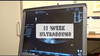 FIRST ULTRASOUND | 11 WEEKS