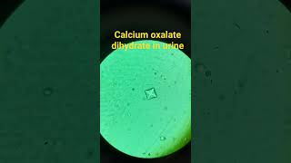 Calcium oxalate dihydrate seen in urine sample