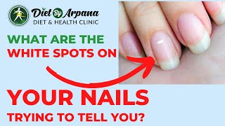 What are the White Spots on Your Nails Trying to Tell You? #dietbyarpana #zinc #zincdeficiency