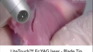 LiteTouch Er:YAG laser  - Blade Tip