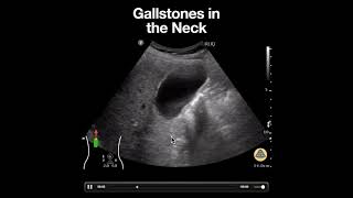 Gallstones in the Neck of the Gallbladder