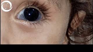 Ophthalmic Signs Sclera