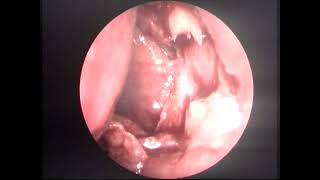 Endoscopic DCR under LA ,single handed, 2016 unedited-dr.shreekantha acharya