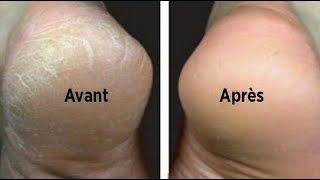 Astuce naturelle pour traiter les pieds secs et fendillés