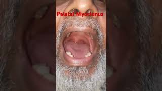 Palatal Myoclonus (Palatal Tremor) 🧠 #tremor #essentialtremor #parkinson