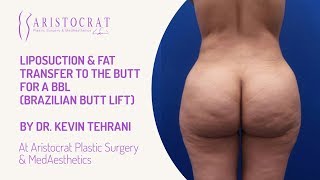 Liposuction & Fat Transfer to the Butt for a BBL Long Island, New York by Dr. Kevin Tehrani