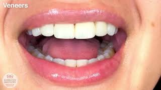 Veneers