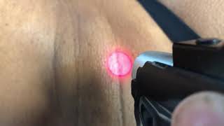 Laser hair removal on underarms of a black woman