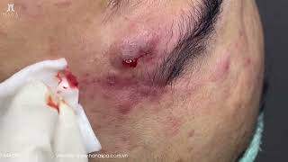 Big Cystic Acne Blackheads Extraction Blackheads & Milia, Whiteheads Removal Pimple Popping