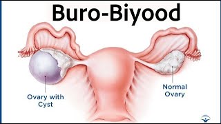 Buro Biiyoodka Minka || Poly cyst ovarian syndrome || PCOS || caafimaad