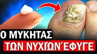 Θυμηθείτε 1 λαϊκό τρόπο πώς να απαλλαγείτε από τον μύκητα των νυχιών των ποδιών (σημαντικό)