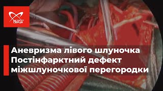 Аневризма лівого шлуночка. Постінфарктний дефект міжшлуночкової перегородки 🔷 Інститут серця