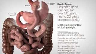 Bariatric Surgery Referral