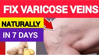 Home Remedies To Treat Varicose Veins | Natural Remedies| How to get rid of varicose veins