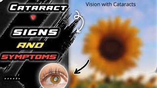 Cataract Symptoms Uncovered: Prepare to Be Amazed