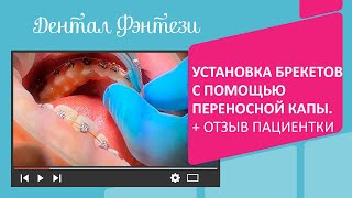 👉 Установка брекетов с помощью переносной капы. Отзыв пациентки