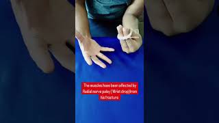 Radial nerve palsy/Shaft of humerus fracture/Wrist drop/Home exercises for wrist drop/strengthening