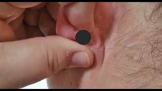 Top 10 Pimple Pops, Summer 2020!  Pimple Popping, Blackheads and Zits Poppers