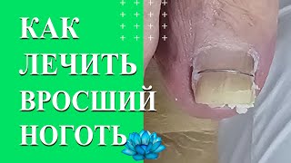 Титановая нить. Вросший ноготь на ноге. Коррекционная система.