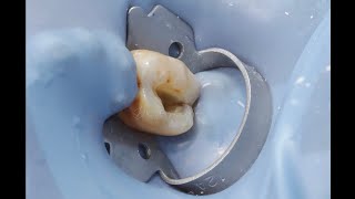 Tips for perfect single tooth isolation in endodontics