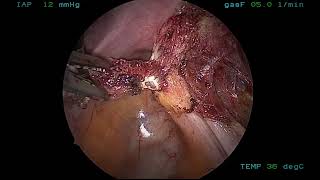 MiniLap® Percutaneous System - Endometriosis with Alligator Grasper