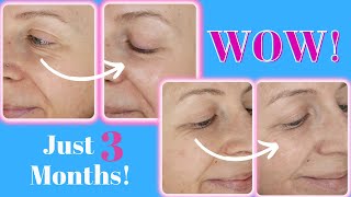 Nira 3 Month Results with Before and Afters | At-Home Laser | Mature Beauty