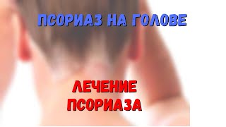 Псориаз на голове. Лечение псориаза