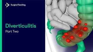 Diverticulitis Part 2 | How Common is it and What Symptoms do Patients Present with?